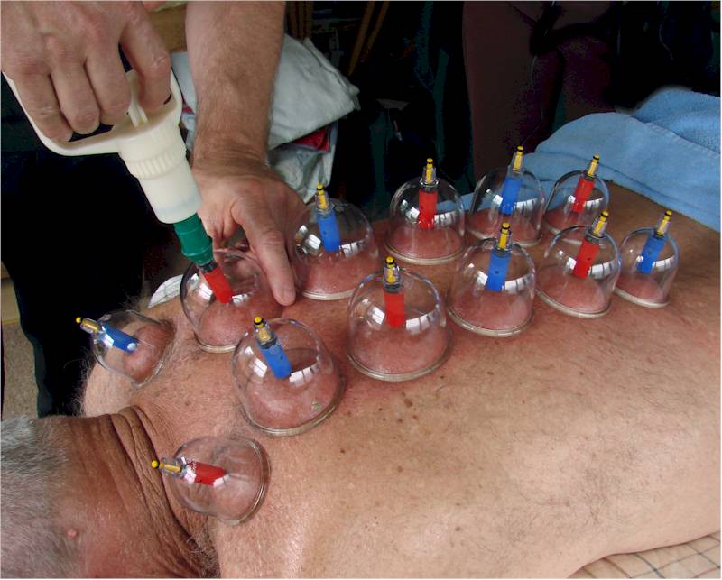 Cupping is a powerful detoxifying, pain relieving and energy building modality.